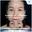 Subbrow Lift ยกหางตาและกระชับเปลือกตาบนโดยหมอเฉพาะทาง