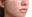 รักษาหลุมสิว(Atrophic Scars) อย่างไรให้หน้าใสเรียบเนียน